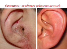 Отомикоз - заболевание ушей