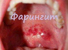 фарингит - воспаления в полости рта